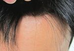 男性かつらモデル画像生え際アップ